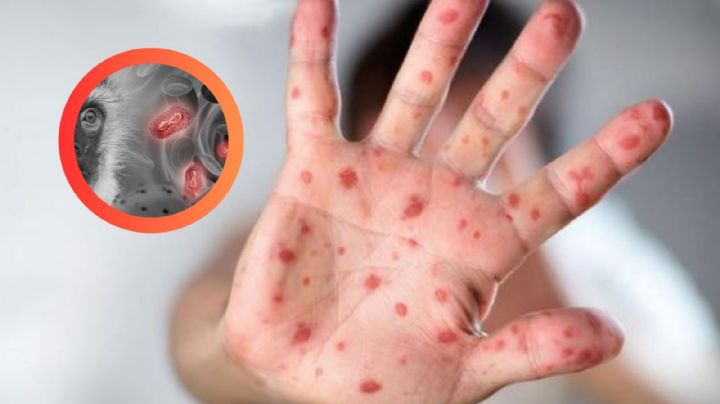 ¿Vacuna contra la viruela del mono?, descubre si tendrá costo y cómo obtenerla