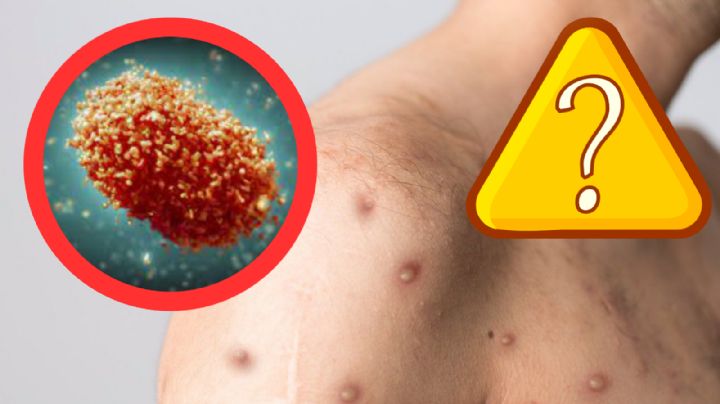 Mpox: ¿hay vacunas en México y cuáles son los tratamientos disponibles?
