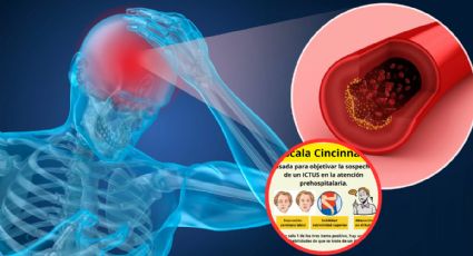 Así se detecta un derrame cerebral; haz la diferencia entre la vida y la muerte