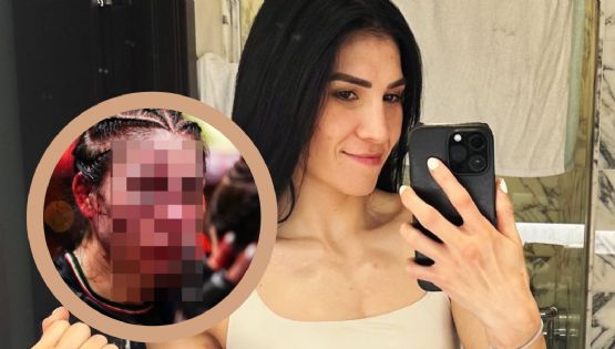 ¿Desfigurado?, así quedó el rostro de Irene Aldana, tras impactante corte en pelea de UFC