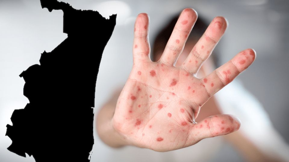 Mpox, con fuerte presencia en Tamaulipas