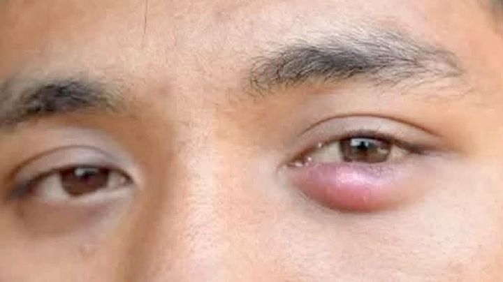 ¿Qué son y por qué salen las 'perrillas'?; remedios, mitos y verdades