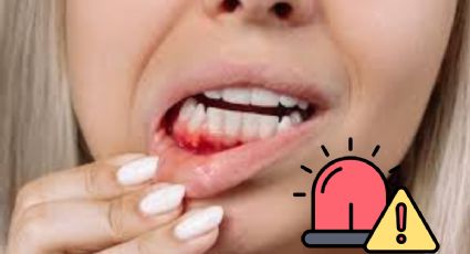 ¿Qué significa el sangrado en las encías y cuándo debe preocuparse?; esto dicen los expertos