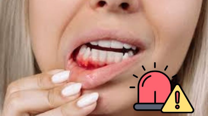 ¿Qué significa el sangrado en las encías y cuándo debe preocuparse?; esto dicen los expertos