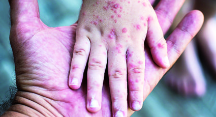 Atención Nuevo Laredo: detectan al menos 5 casos de Coxsackie en escuelas