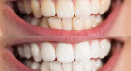Así puedes eliminar el sarro de tus dientes; sin bicarbonato ni limón y sin ir al dentista