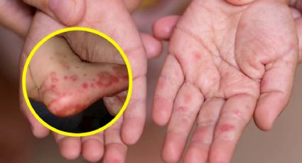 Hay infección viral en Tamaulipas; afecta a los niños y estos son los síntomas