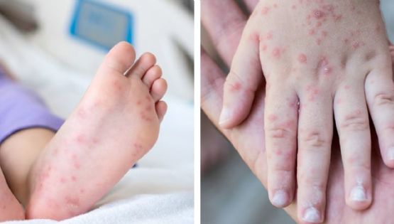 El temido virus Coxsackie contagia a niños en escuelas y provoca regreso a clases en línea