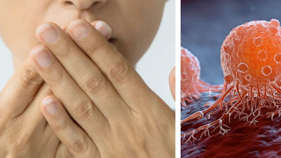 El cáncer y el mal aliento