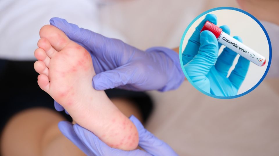 Detectan seis casos de Coxsackie en Nuevo Laredo