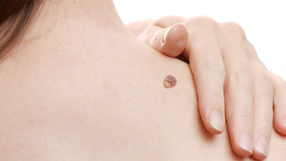 ELimina las molestas verrugas.