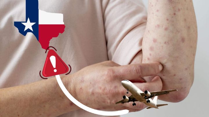 Alertan a viajeros por brote de sarampión en Texas; en estos condados hay más contagios