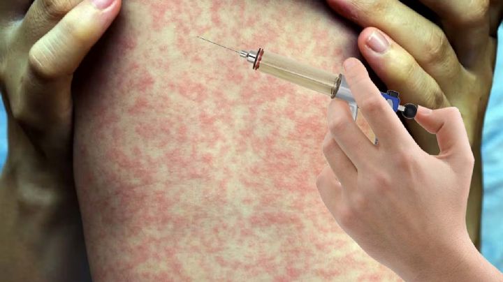 No hay que alarmarse por sarampión, pero no hay que bajar la guardia: Sanidad de Laredo