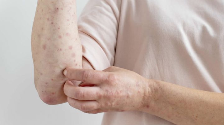 ¿Cómo identificar si alguien está contagiado con sarampión?