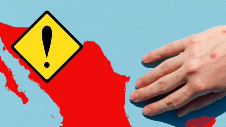 Sarampión en México: ¿qué diferencias hay con la varicela y cuáles son sus síntomas