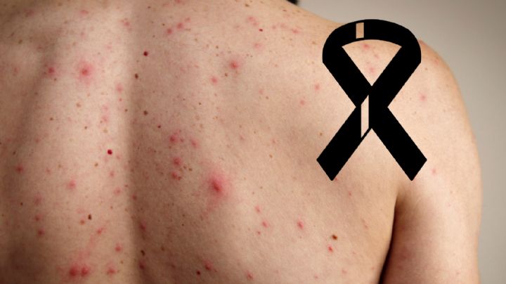 Sarampión cobra la vida de un hombre en México; ¿en dónde fue?