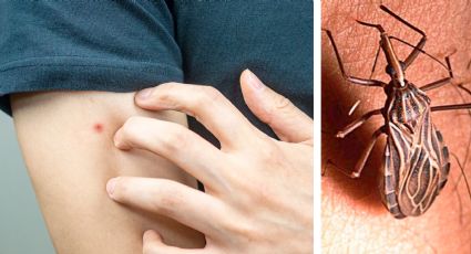 ¿Cómo saber si estás enfermo del mal de Chagas?, la enfermedad mortal transmitida por chinches