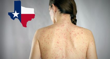 Texas lidera los contagios de sarampión en EU; ¿cuántos casos se reportan?