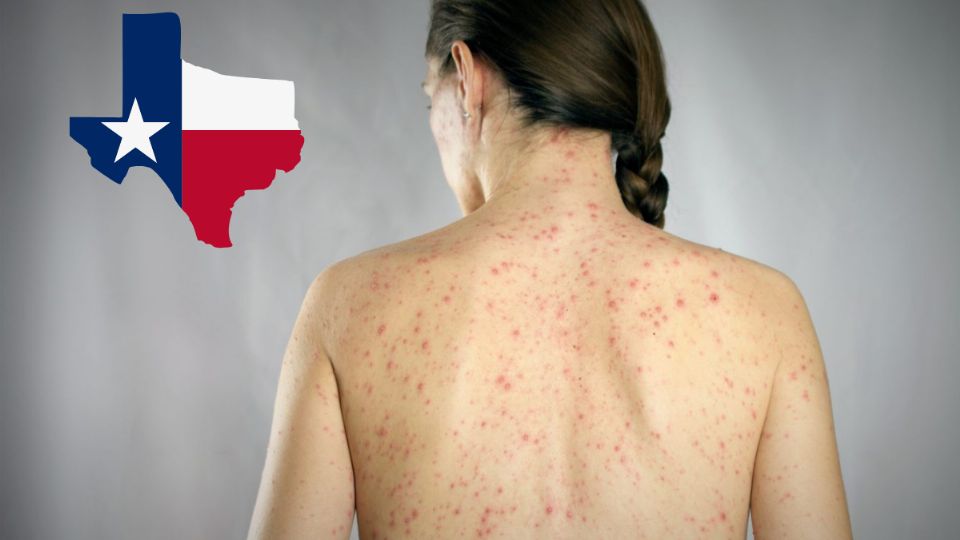Las autoridades han iniciado campañas de vacunación para frenar el brote