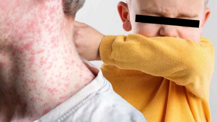 Reportan más casos de Tos ferina y Sarampión: Secretaría de Salud pide vacunarse 