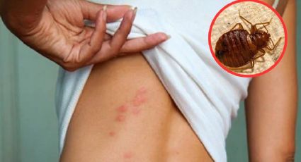 Chinches transmiten enfermedad silenciosa durante la temporada de calor; ¿de qué se trata?