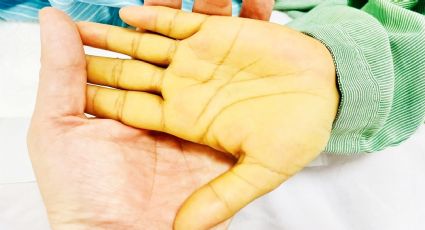 La piel de una mujer se pone de un amarillo tan intenso que casi le provoca la muerte