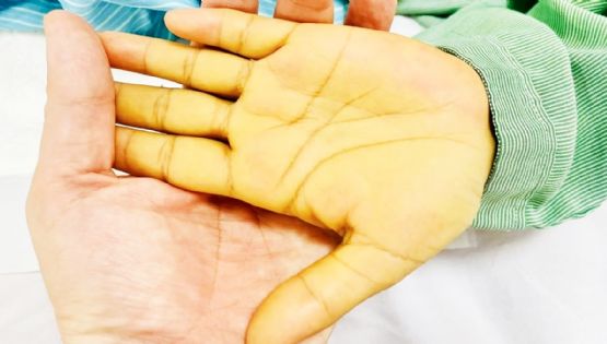 La piel de una mujer se pone de un amarillo tan intenso que casi le provoca la muerte