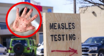 Alerta en Texas por brote de sarampión; es el estado en EU con más casos