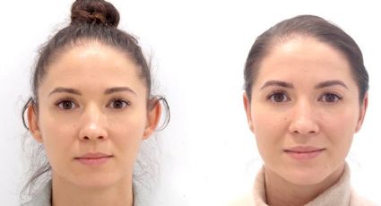 Cirugía de orejas: la otoplastia, una solución estética para mejorar la autoestima