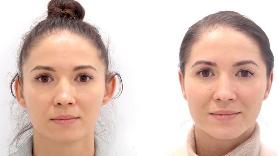 EL antes y después de una otoplastia
