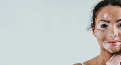 ¿Ya existe una cura para el vitiligo?; así puedes combatir este terrible mal