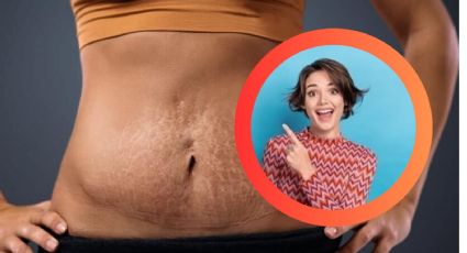 ¿Tienes estrías rojas?, descubre por qué aparecen y cómo desvanecerlas