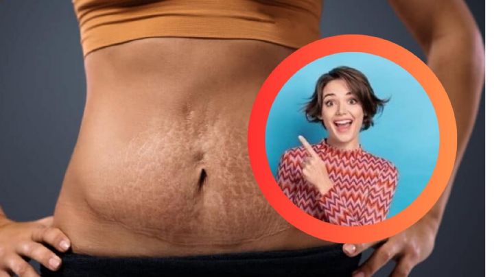 ¿Tienes estrías rojas?, descubre por qué aparecen y cómo desvanecerlas