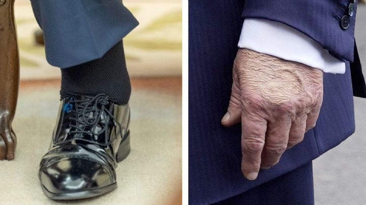 Insuficiencia venosa crónica: ¿es mortal la enfermedad que padece Donald Trump?