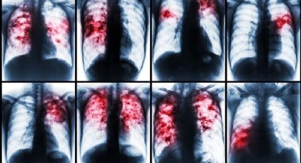 Casos de tuberculosis serán detectados en alta resolución en Laredo: viene nuevo equipo de rayos X