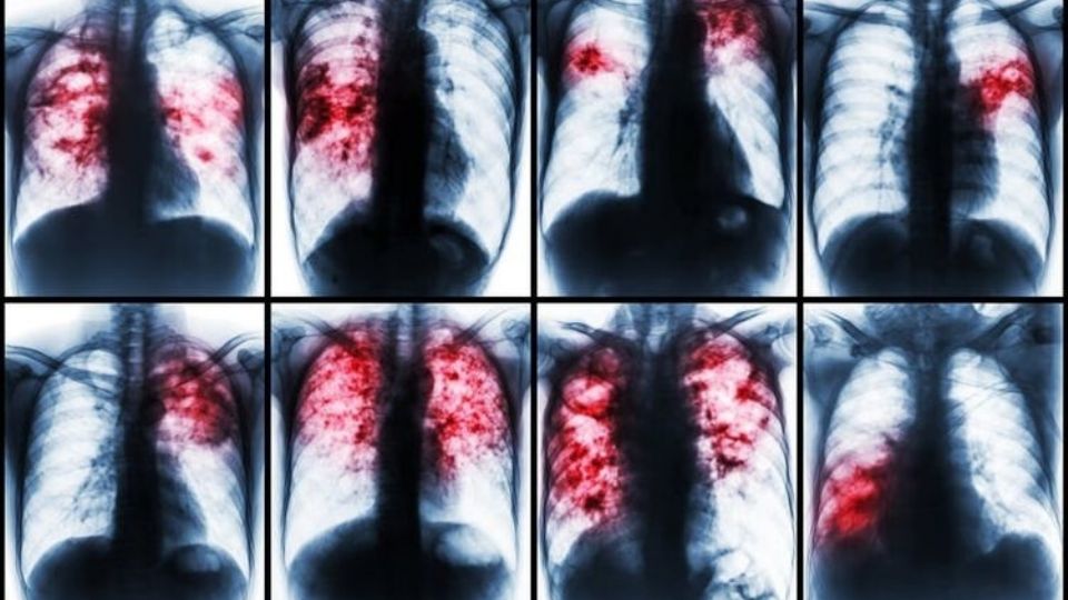 Tuberculosis en Laredo