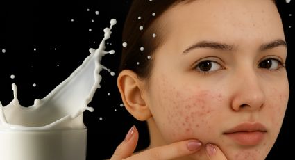 Esta es la leche que podría estar causando tu acné, según estudios dermatológicos