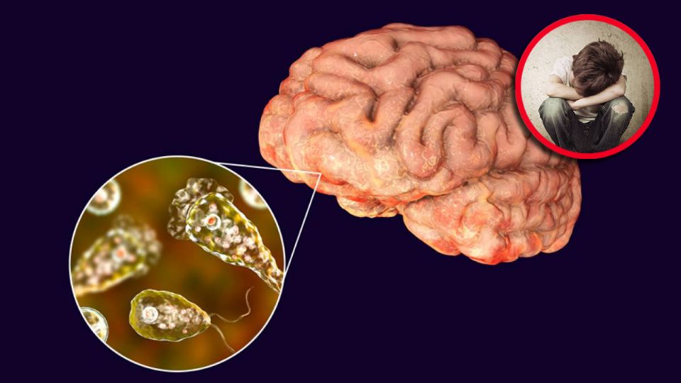 La infección ocurre cuando el agua contaminada entra por la nariz, generalmente durante actividades acuáticas como nadar o bucear