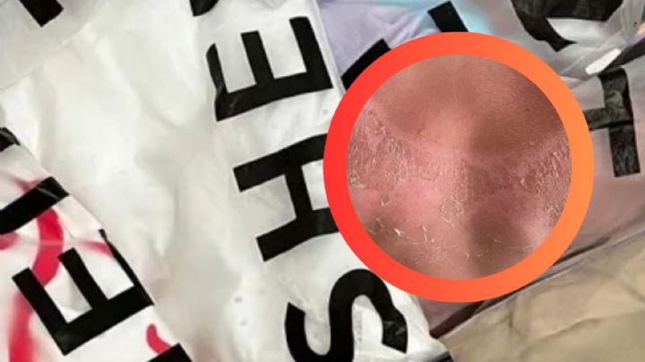 Mujer sufre severas quemaduras tras usar esta prenda de Shein; así respondió la famosa marca