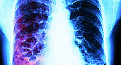 Mueren 12 a causa de la tuberculosis en Nuevo Laredo