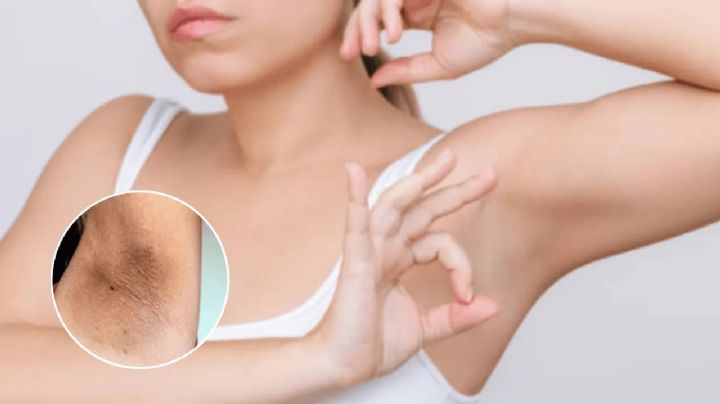 Axilas oscuras: el 'secreto' detrás de blanquearlas podría estar en tu botiquín | VIDEO