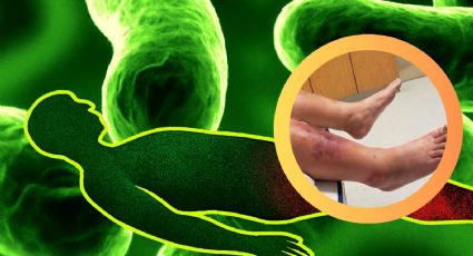 Emiten alerta por 'bacteria devoradora de carne'; ya hay 89 muertos