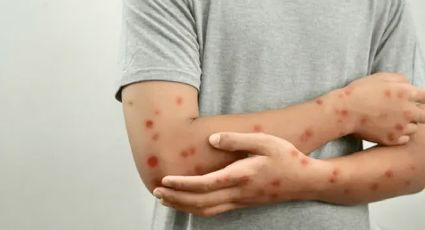 Alerta sanitaria: regresa la viruela del mono a México; detectan nuevo caso en este estado