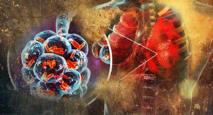 Tuberculosis en Nuevo Laredo: ¿cómo se transmite y cuáles son los síntomas?
