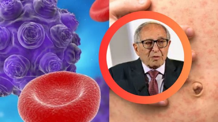 Sarampión en México: ¿cuántos fallecimientos se han registrado por contagio?