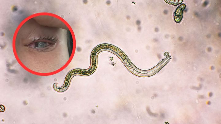 Joven queda ciega de un ojo por culpa de parásito que se comió su córnea; esto pudo causar la infección