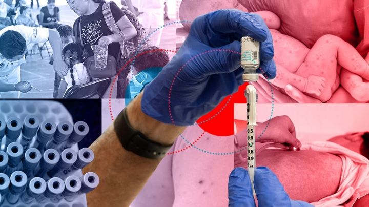 Aplicarán 'dosis cero' contra el sarampión a menores y grupos vulnerables en México