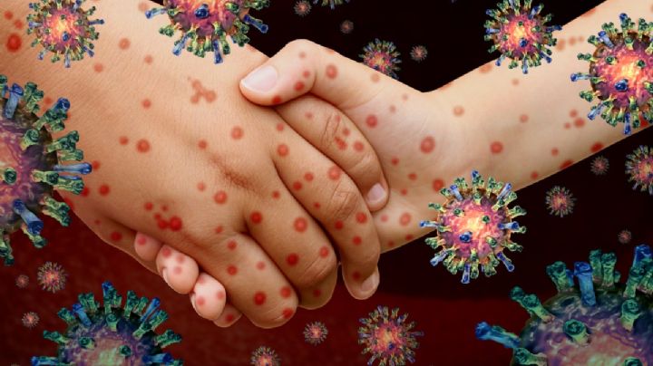 Sarampión: ¿virus puede contagiarte a pesar de haberlo tenido antes?; afecta al 90% de no vacunados