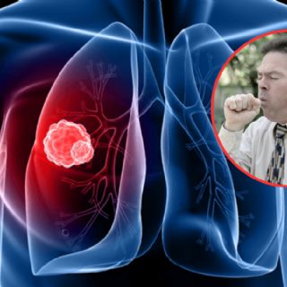 ¿Tos que no se quita?; podría ser una alerta temprana de cáncer de pulmón