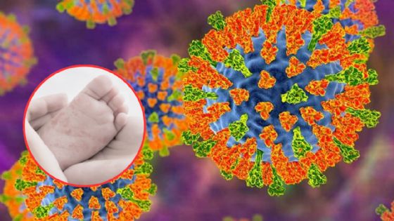 Tragedia en Tlaxcala: bebé muere por sarampión; no tenía su esquema de vacunación completo